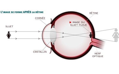 Schéma explicatif de la formation d’une image floue sur la rétine