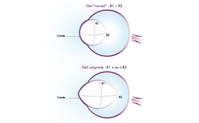 Schéma comparant un œil normal et un œil astigmate selon la courbure de la cornée