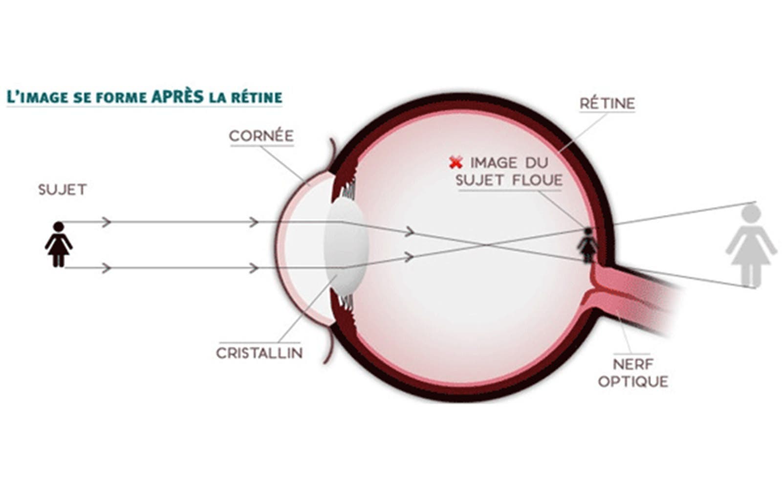 Schéma explicatif de la formation d’une image floue sur la rétine